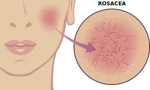 What causes Rosacea?